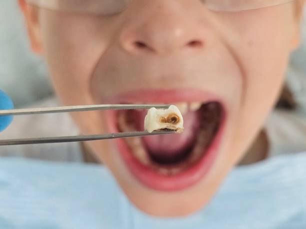 Best Emergency Tooth Extraction in Newark, NY